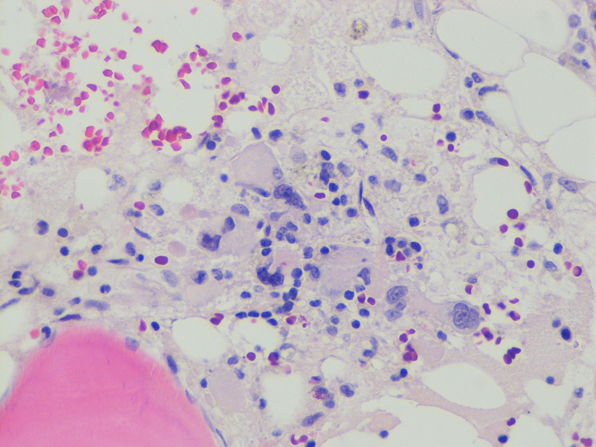Bone marrow biopsy (H&E): megakaryocytes